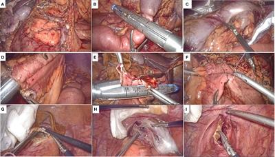 Short-term and long-term survival outcomes for transrectal specimen extraction after laparoscopic right hemicolectomy: a propensity-score matching study